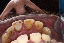 Open apex management - Procedure photo Case 3